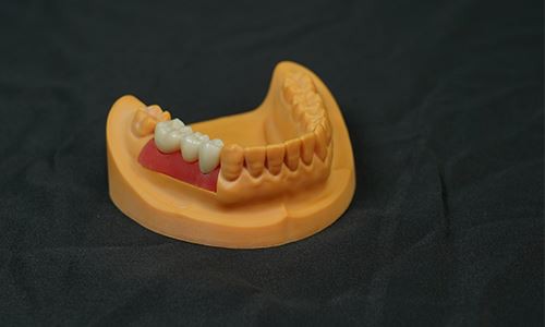 Full Polymer Porcelain Dental Implant