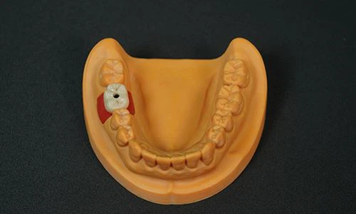 Emax-All-ceramic-Implant